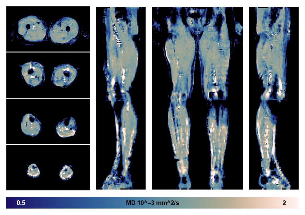 IVIM corrected whole leg muscle mean diffusivity obtained from diffusion tensor imaging.